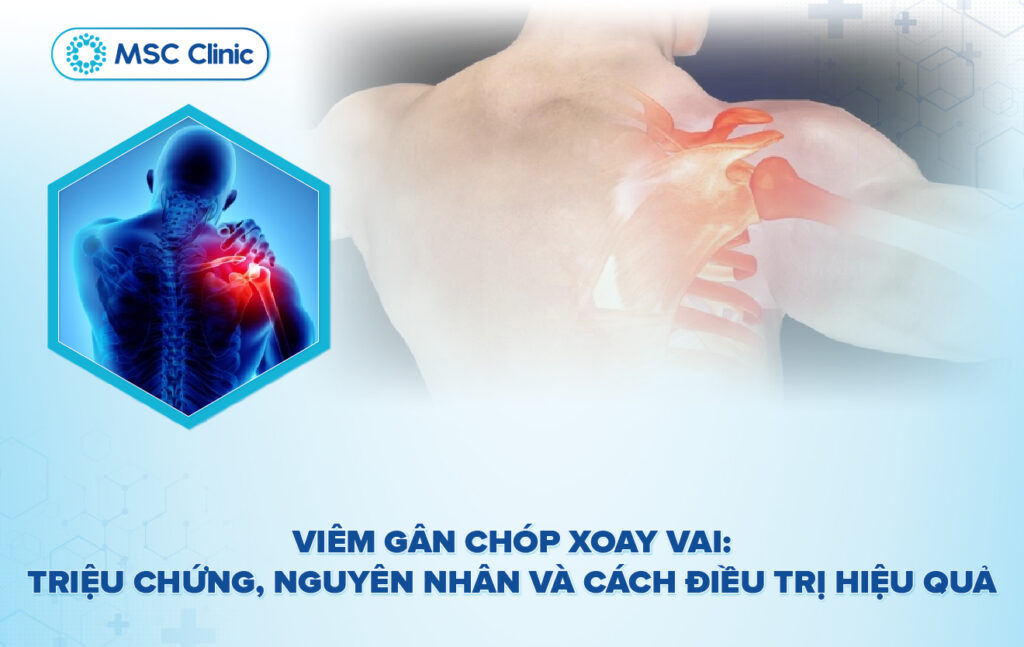 Viêm gân chóp xoay vai: Triệu chứng, nguyên nhân và cách điều trị hiệu ...