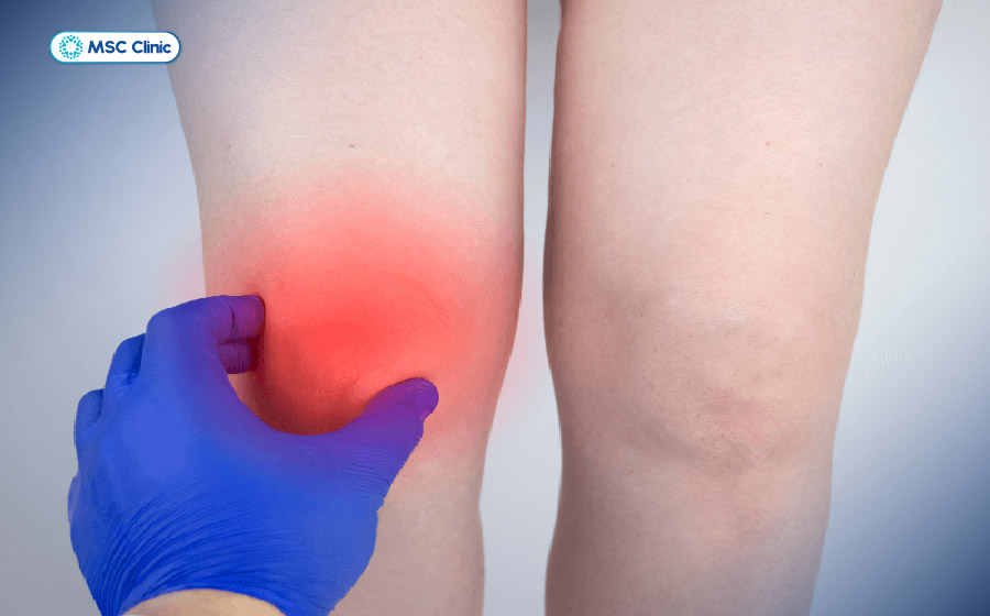 Đầu gối sưng nề là một trong những dấu hiệu của giãn dây chằng