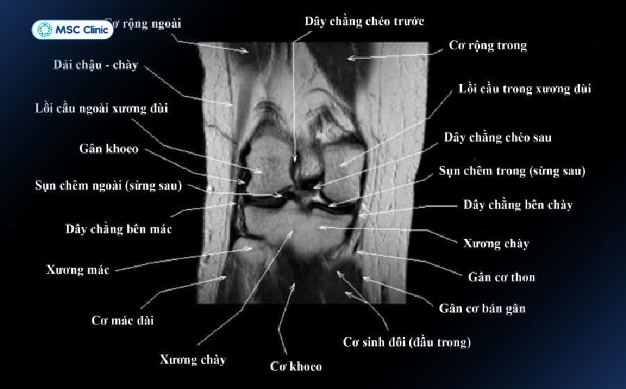 Hình ảnh chụp MRI dây chằng khớp gối 
