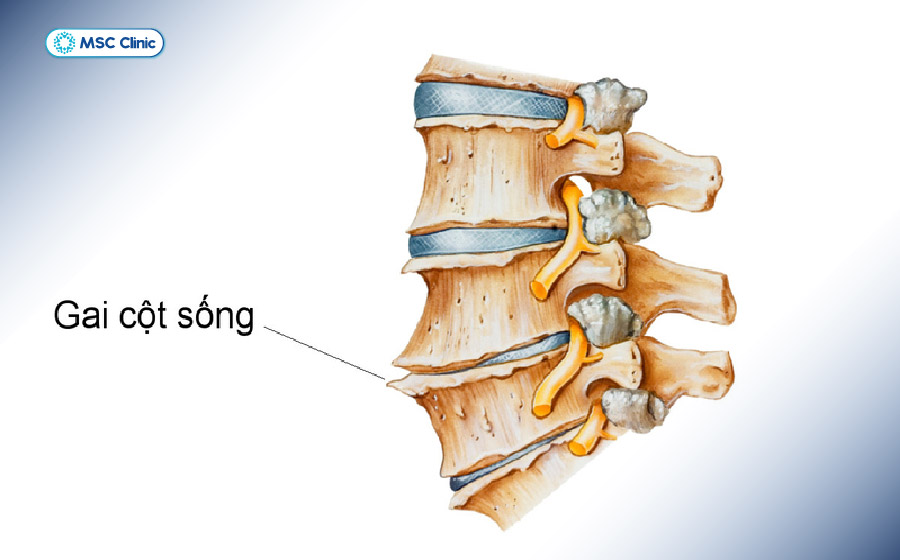 Hình ảnh cột sống mọc thêm các gai xương