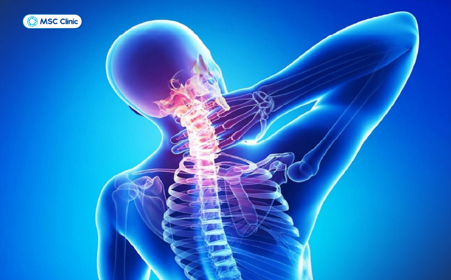 Thoái hóa kéo dài khiến cấu trúc cột sống dần thay đổi và làm tăng nguy cơ hình thành gai xương