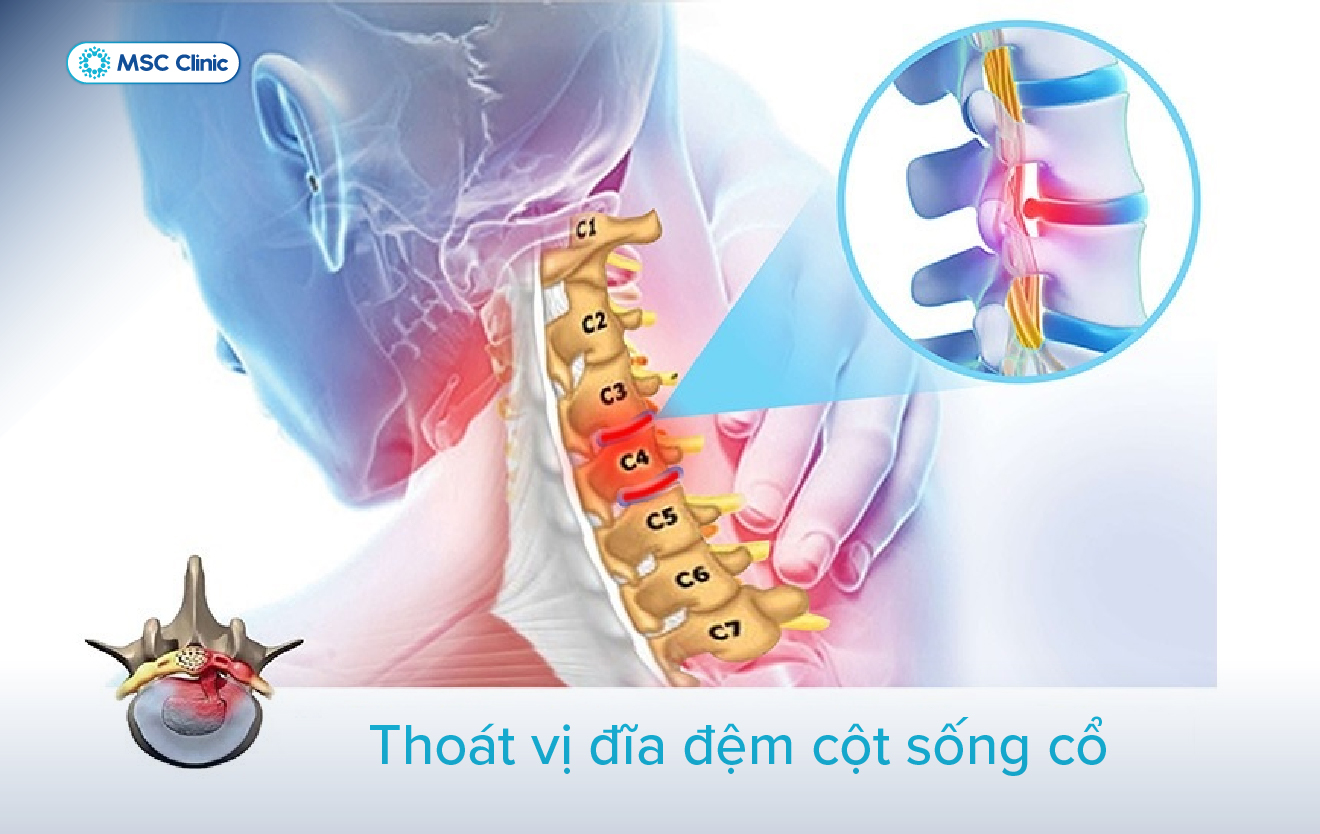 Đau vai là một trong những triệu chứng của thoát vị đĩa đệm cổ