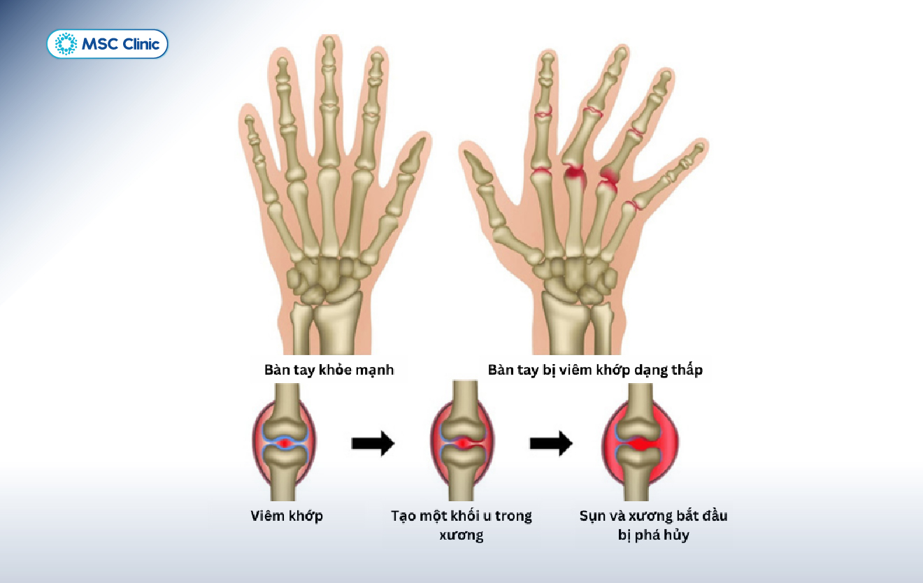 Nhiều người nghĩ viêm khớp dạng thấp chỉ gây đau tay, nhưng thực tế bệnh còn lan tới vai