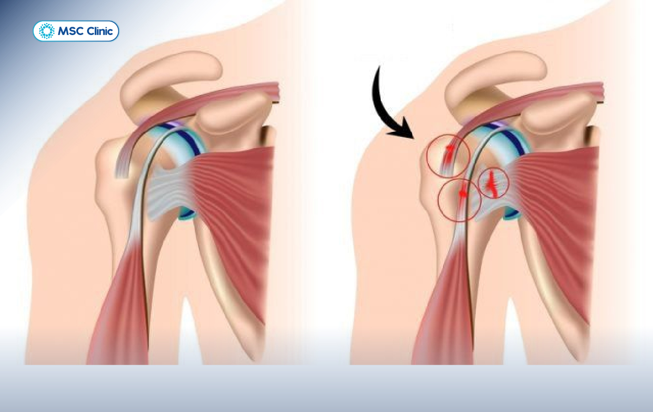 Rách gân cơ chóp xoay gây đau dai dẳng, có thể ảnh hưởng đến khả năng vận động khớp