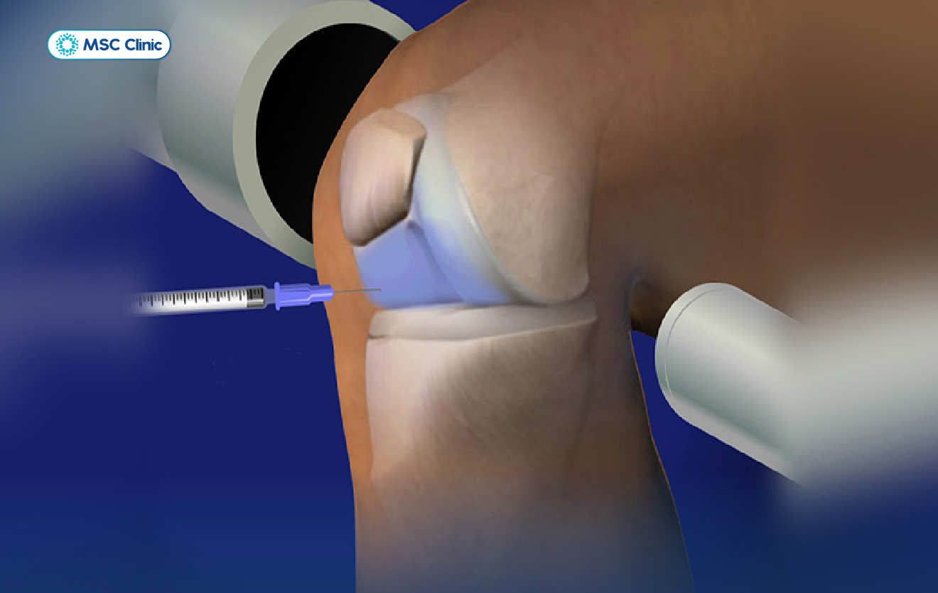 Tiêm corticosteroid giúp giảm đau nhanh nhưng không nên lạm dụng