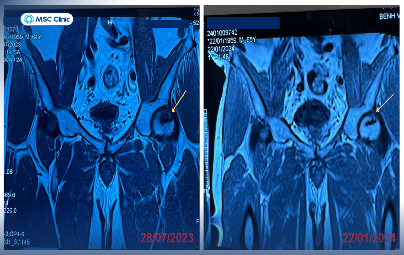 Thực hiện siêu âm nhằm xác định chính xác vùng tổn thương ở khớp gối do chấn thương thể thao trước khi tiêm PRP