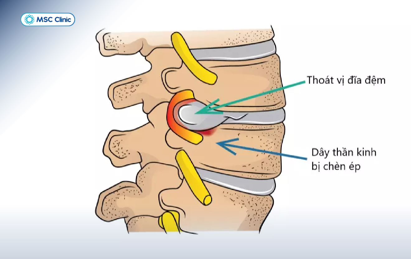 Tình trạng thoát vị đĩa đệm chèn ép lên dây thần kinh