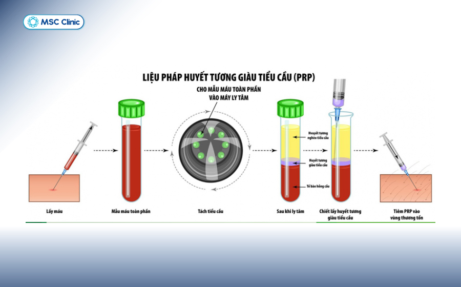 Tiêm huyết tương giàu tiểu cầu PRP là phương pháp hiện đại điều trị thoái hóa khớp gối giúp giảm đau nhanh, hồi phục chức năng vận động và có tác dụng lâu dài