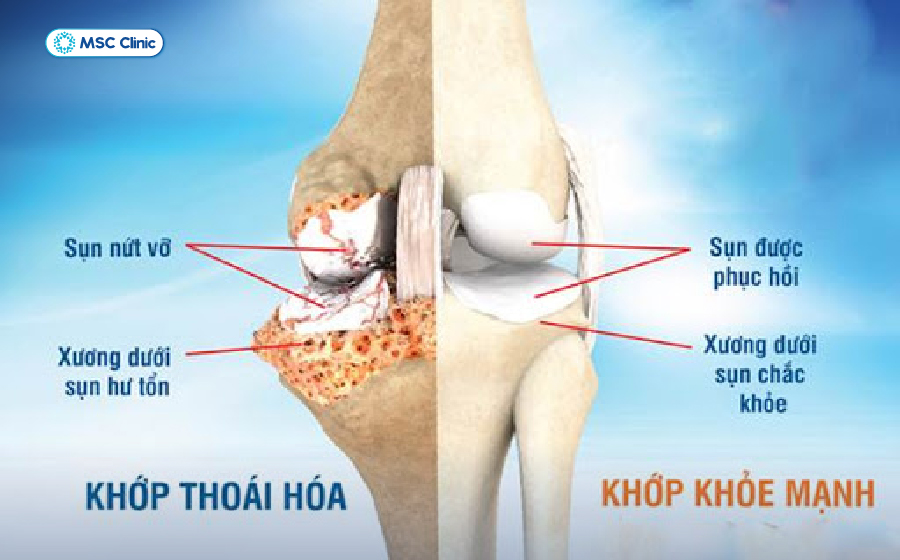 So sánh trạng thái khớp gối bình thường và thoái hóa