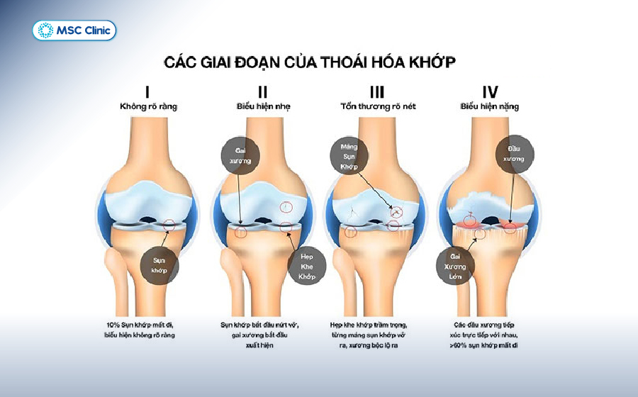 Thoái hóa khớp gối độ 1 và 2 là thời điểm “vàng” để chăm sóc và điều trị kịp thời, hiệu quả