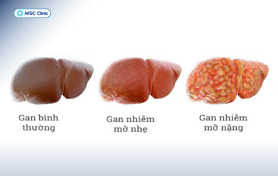 Gan nhiễm mỡ giai đoạn 3 làm biến đổi tình trạng gan gây các biến chứng nguy hiểm