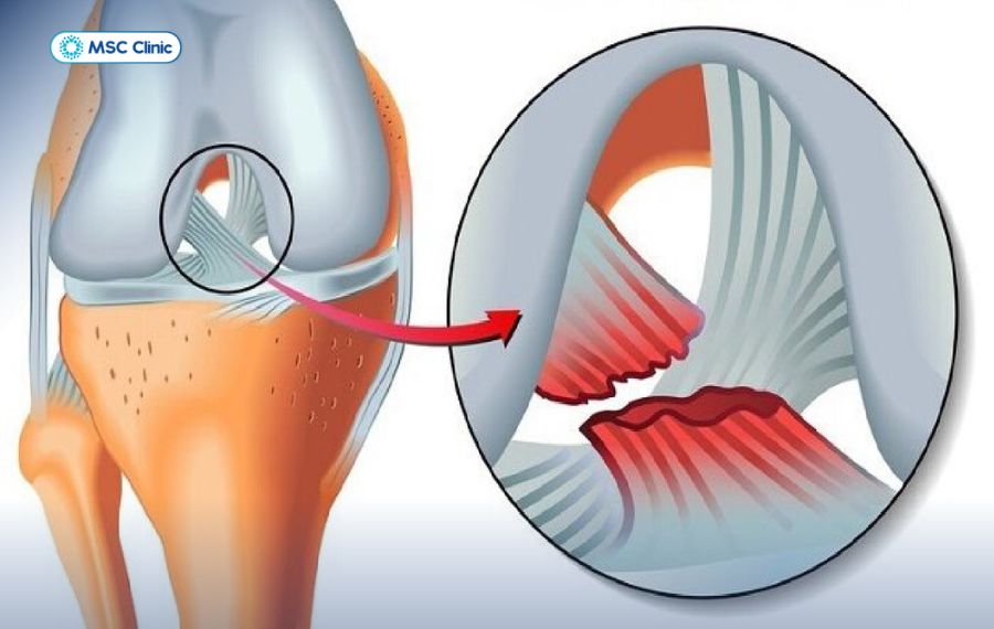 Dây chằng chéo trước (ACL) là một trong 4 dây chằng chính của đầu gối 