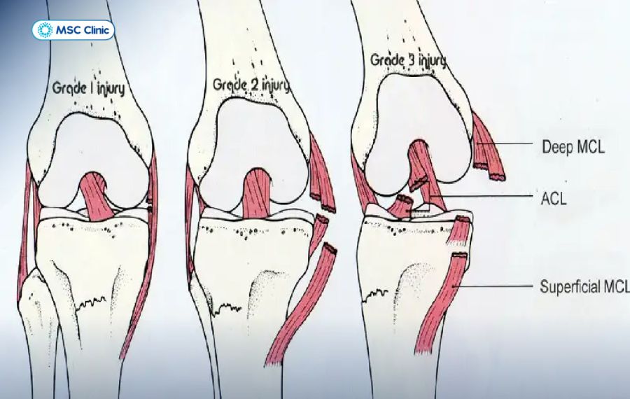 Chấn thương dây chằng trong khớp gối được chia làm 3 mức độ chính
