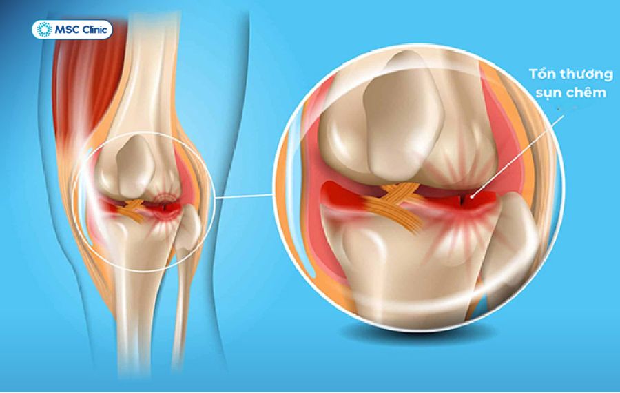 Biến chứng tổn thương sụn chêm gây đau nhức dữ dội và tăng dần khi vận động đầu gối 