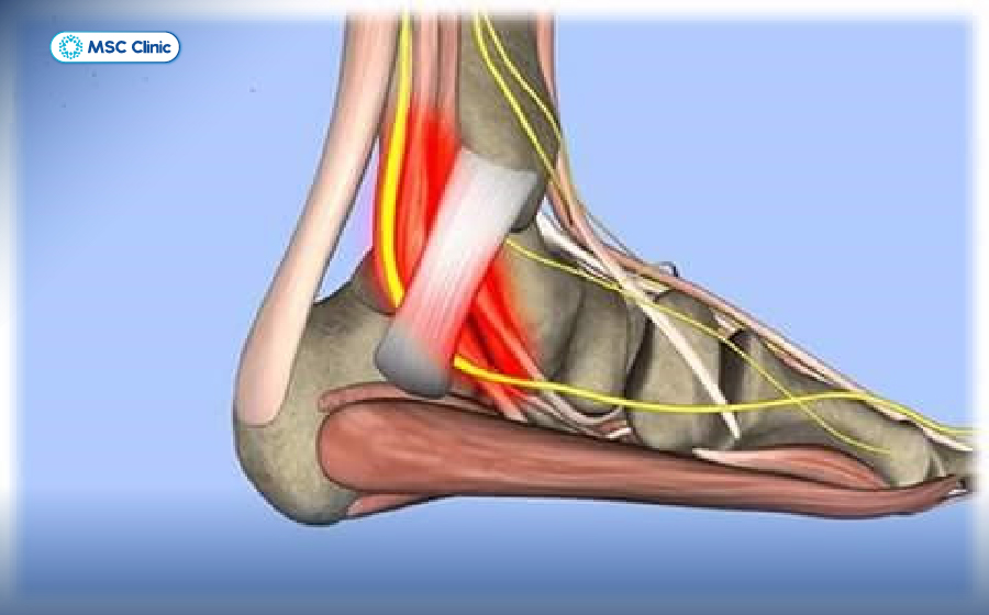 Đau khớp cổ chân nhưng không sưng có thể là dấu hiệu tiềm ẩn của bệnh lý hội chứng ống cổ chân