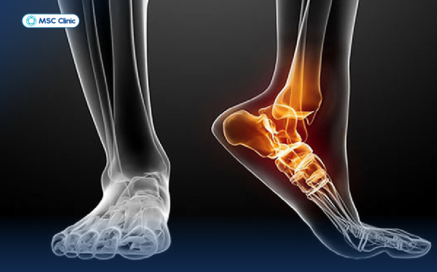 Thoái hoá khớp cổ chân có thể gây ra tình trạng đau cổ chân nhưng không sưng