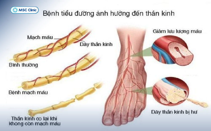Bệnh lý thần kinh ngoại biên thường bị nhầm lẫn với bệnh cơ xương khớp, do đó người bệnh cần thăm khám chuyên sâu để phân biệt
