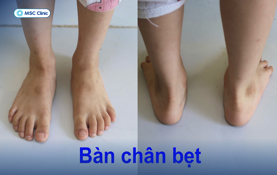 Bàn chân bẹt ở trẻ là một tình trạng rất phổ biến nhưng thường dễ bị bỏ qua