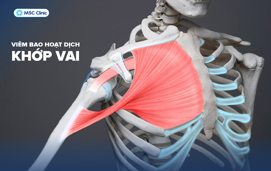 Viêm bao hoạt dịch khớp vai có nguy cơ ảnh hưởng tới khả năng vận động nếu không được can thiệp đúng cách
