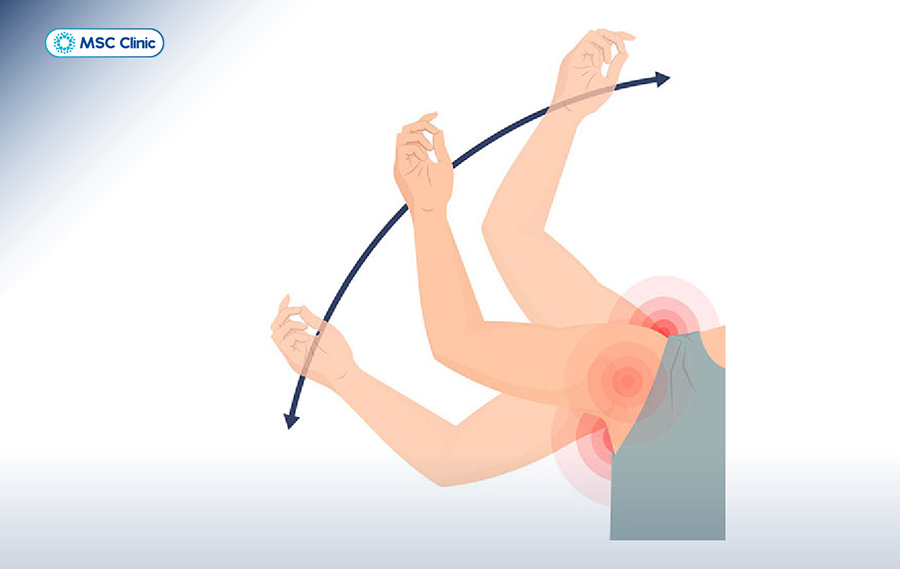 Viêm bao hoạt dịch khớp vai gây đau nhức, đặc biệt khi cử động vai 