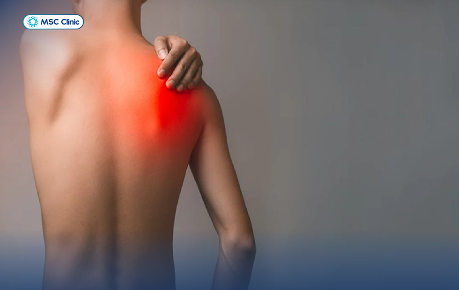 Triệu chứng ban đầu của viêm bao hoạt dịch khớp vai là xuất hiện cơn đau quanh vị trí bên ngoài vai hoặc đầu vai 