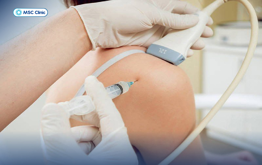 Bác sĩ có thể chỉ định tiêm corticosteroid vào vùng khớp vai bị tổn thương để giảm viêm nhanh chóng trong trường hợp nặng