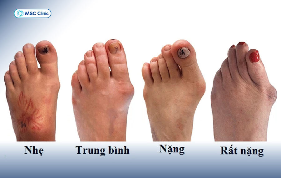 Tình trạng viêm gân về lâu dài không điều trị triệt để có nguy cơ biến dạng bàn chân