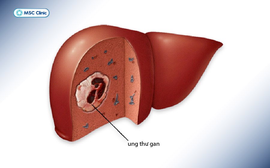 Xơ gan độ 4 có nguy cơ cao chuyển thành ung thư gan