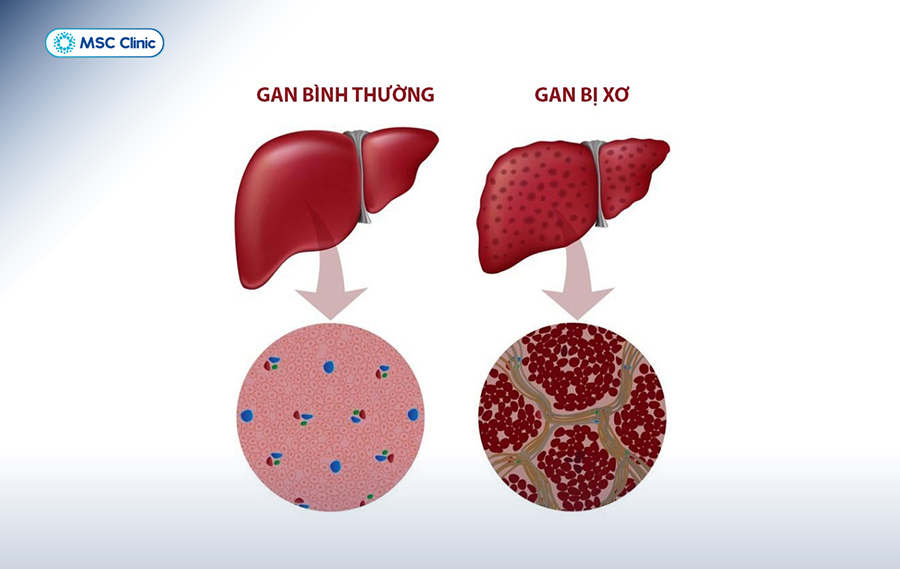 Xơ gan mất bù là gì? Đây chính là giai đoạn nguy hiểm nhất của bệnh xơ gan