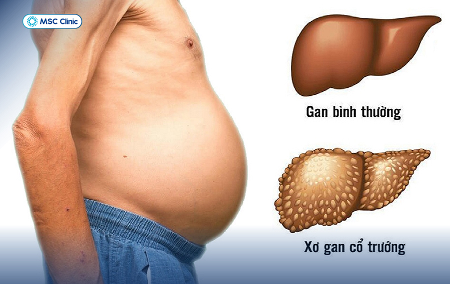 Tình trạng này khiến người bệnh nặng nề, khó thở, đi lại khó khăn và dễ tái phát nếu không được điều trị kịp thời