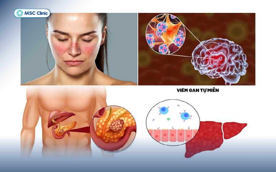 Bệnh gan có lây không và lây truyền qua đường nào-05