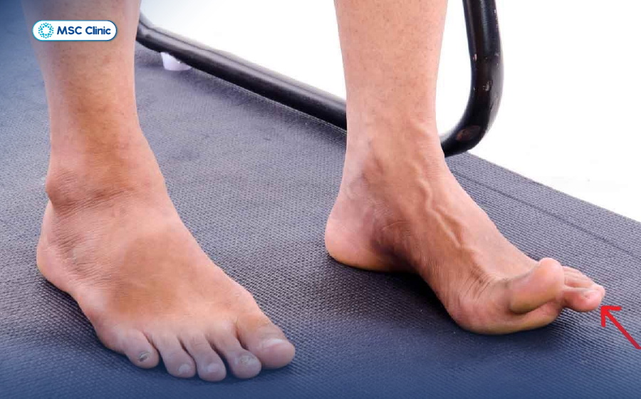 Cách chữa bàn chân bẹt tại nhà an toàn, dễ thực hiện-07