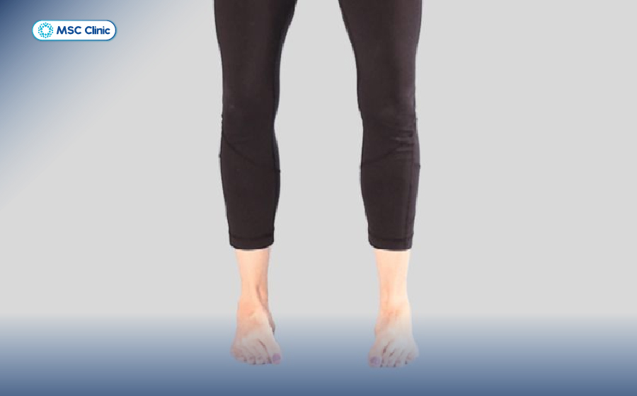 Cách chữa bàn chân bẹt tại nhà an toàn, dễ thực hiện-11