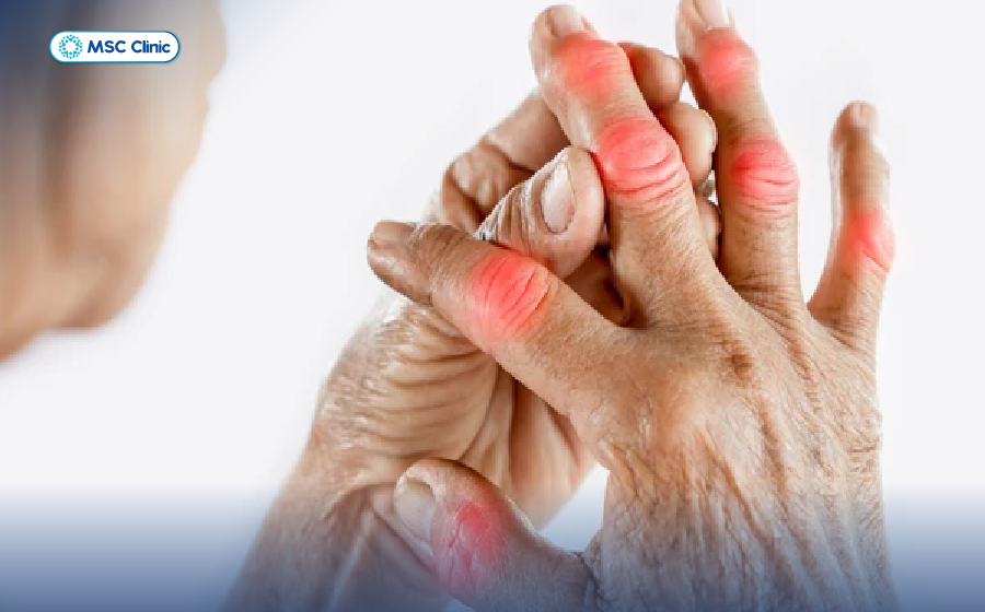Nhận biết chính xác dấu hiệu viêm khớp dạng thấp-04