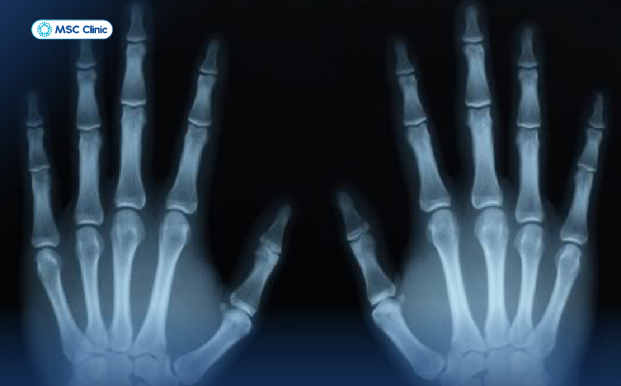 Nhận biết chính xác dấu hiệu viêm khớp dạng thấp-07