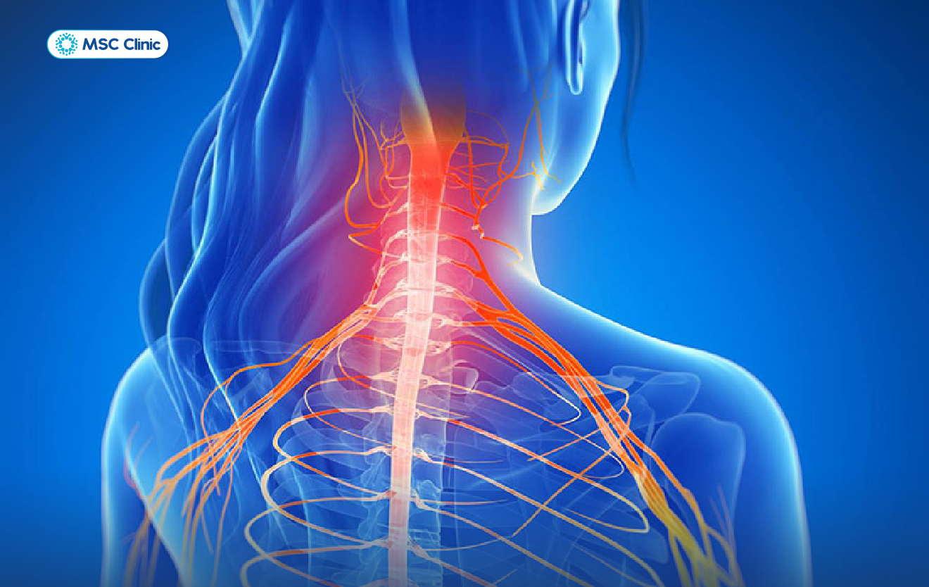 Cơn đau do giãn dây chằng cổ có thể lan từ vai, gáy lên thái dương và gây đau đầu dữ dội