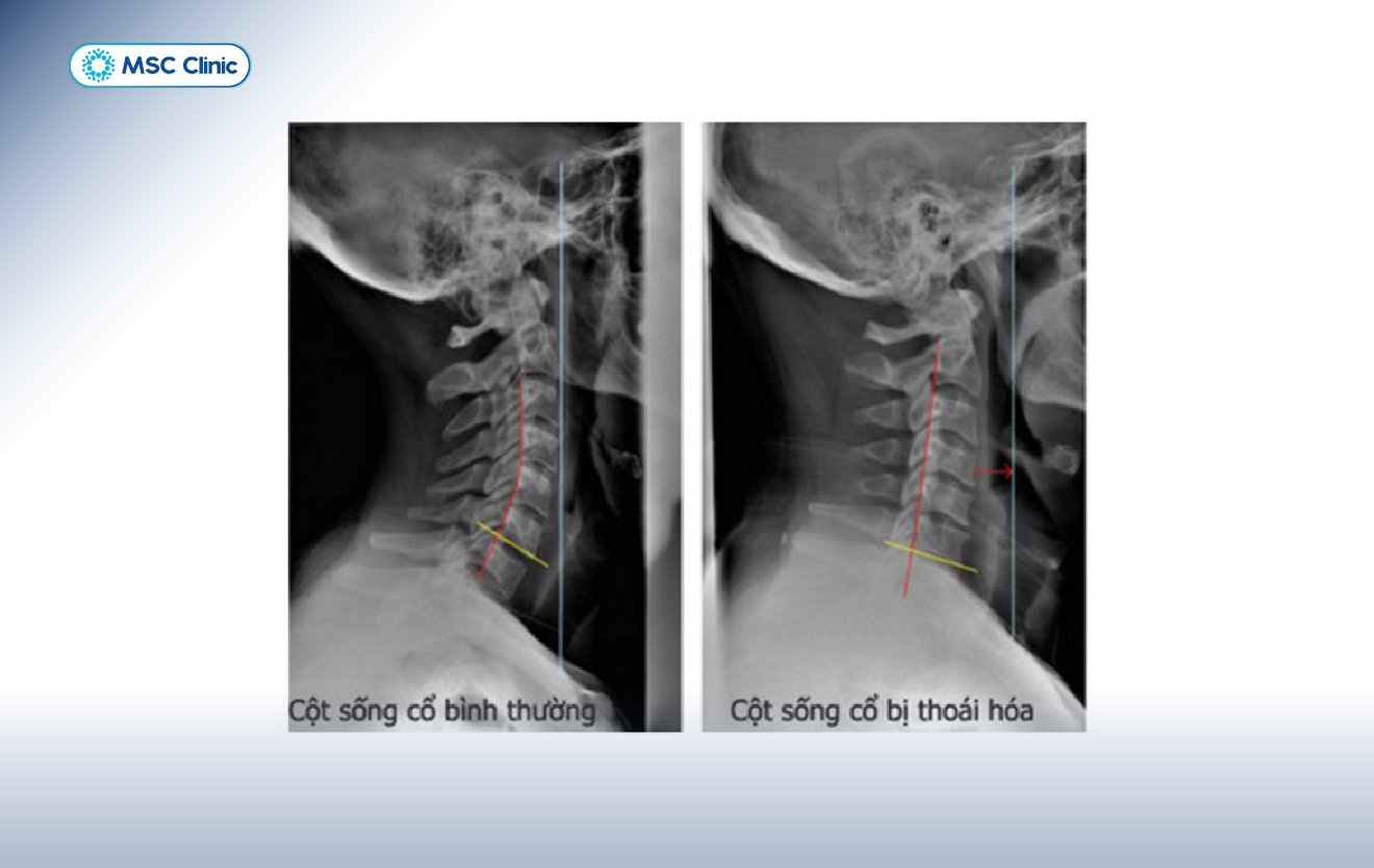 Dây chằng cổ bị giãn không được điều trị làm đẩy nhanh quá trình thoái hóa đốt sống cổ