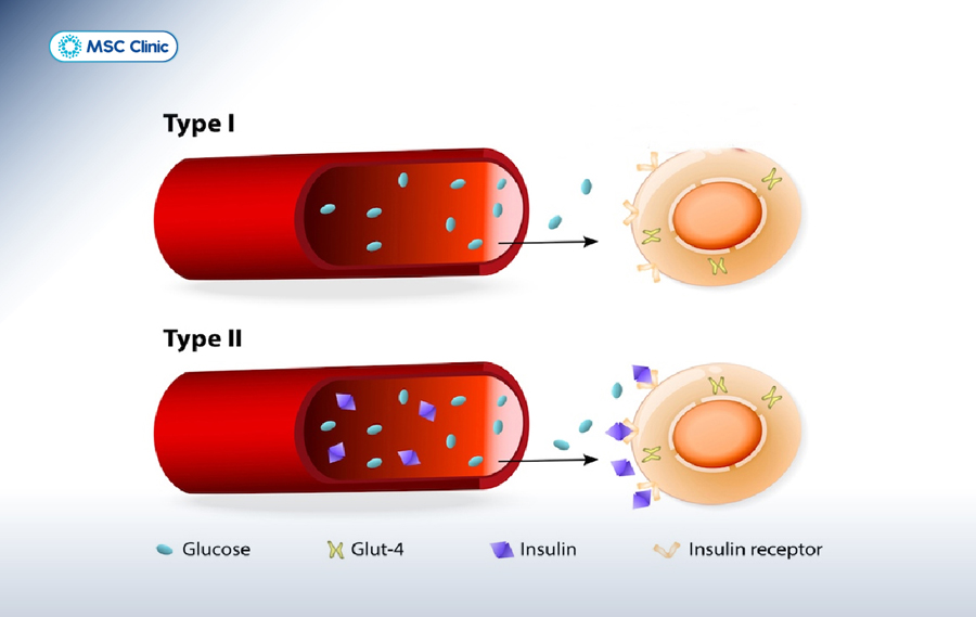 Tiểu đường type 1 do thiếu insulin, còn type 2 do kháng insulin khiến đường huyết tăng cao