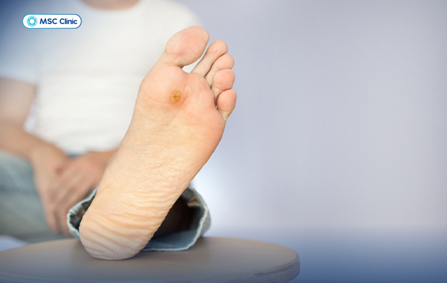 Bàn chân đái tháo đường - biến chứng nguy hiểm có thể cướp đi khả năng đi lại