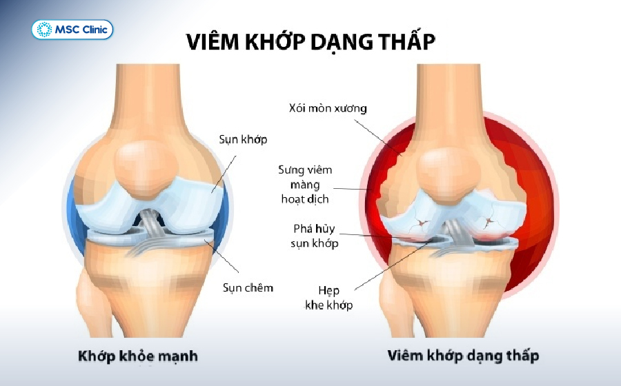 Nguyên nhân viêm khớp gối và cách điều trị an toàn-05