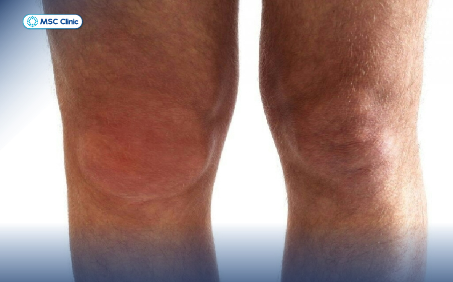 Nguyên nhân viêm khớp gối và cách điều trị an toàn-06