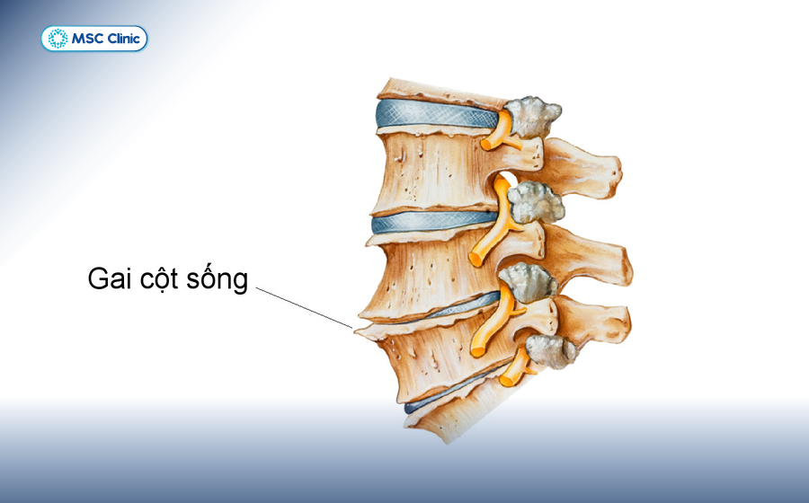 Thoái hóa cột sống và thoát vị đĩa đệm-05