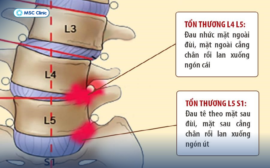 Thoái hóa cột sống và thoát vị đĩa đệm-07