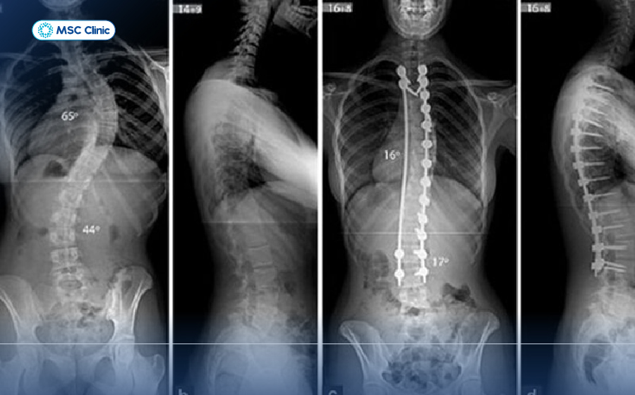 Thoái hóa cột sống và thoát vị đĩa đệm-11