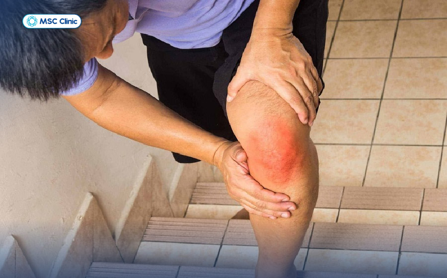 Tràn dịch khớp gối-07