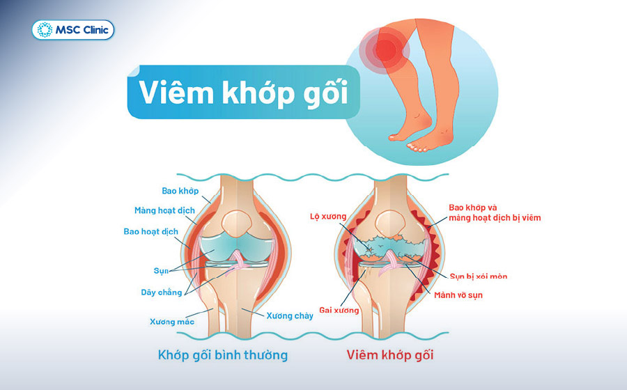 Viêm Khớp Nguyên nhân, triệu chứng và cách điều trị-04