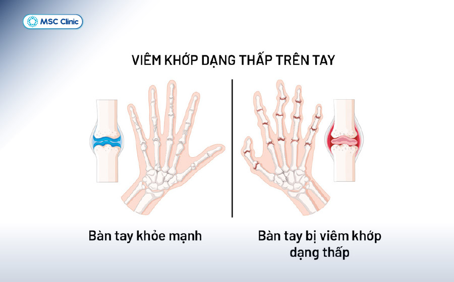 Viêm Khớp Nguyên nhân, triệu chứng và cách điều trị-05