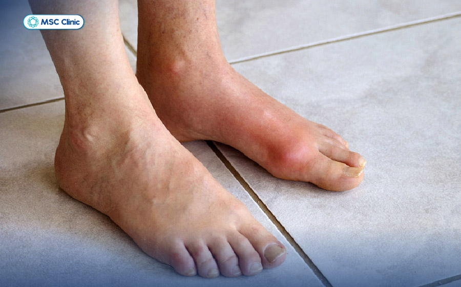 Viêm Khớp Nguyên nhân, triệu chứng và cách điều trị-06