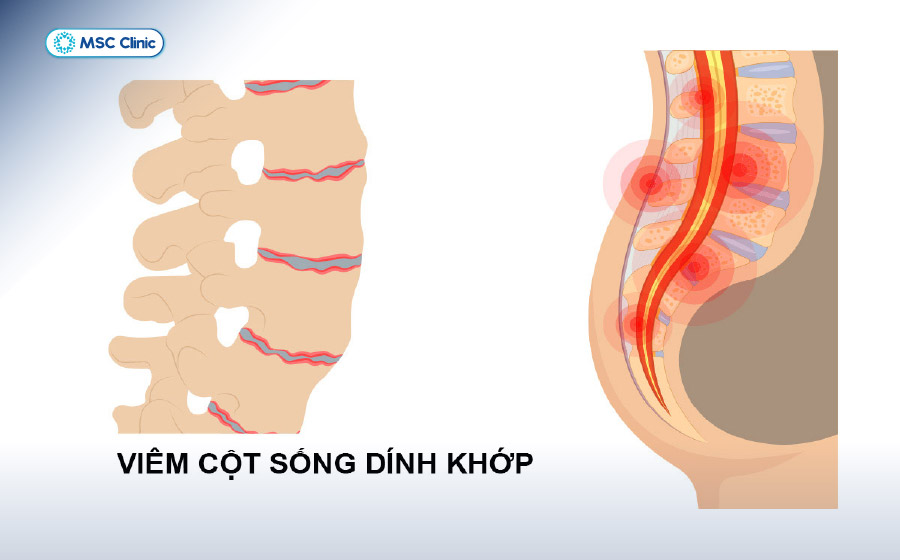 Viêm Khớp Nguyên nhân, triệu chứng và cách điều trị-09