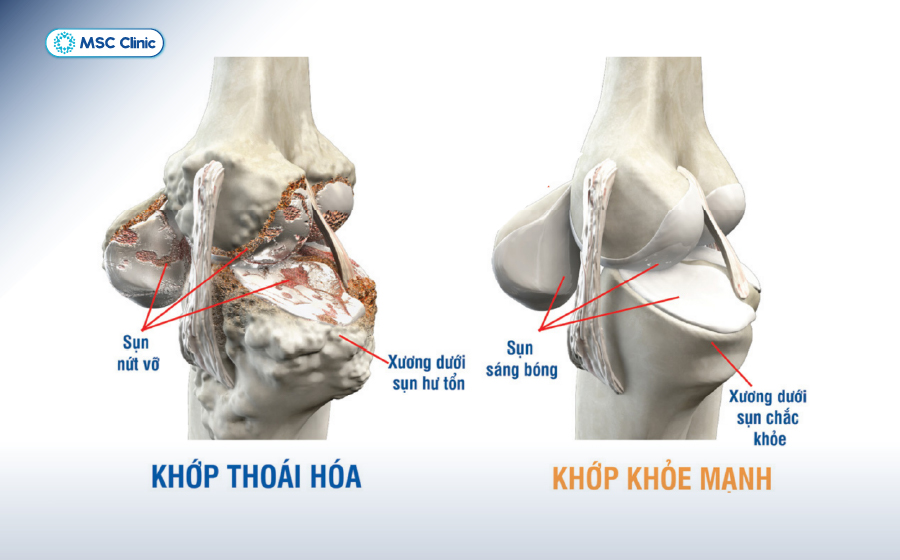Viêm khớp gối Nguyên nhân, triệu chứng và hướng xử lý hiệu quả-05